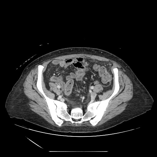 Acinar cell carcinoma of the pancreas (Radiopaedia 75442-86669 Axial C+ portal venous phase 113).jpg
