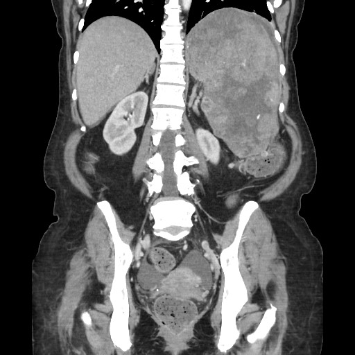 Acinar cell carcinoma of the pancreas (Radiopaedia 75442-86669 Coronal C+ portal venous phase 86).jpg