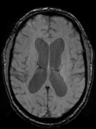 Acoustic schwannoma (Radiopaedia 55729-62281 Axial SWI 30).png