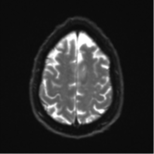 Acoustic schwannoma (Radiopaedia 55729-62281 E 23).png