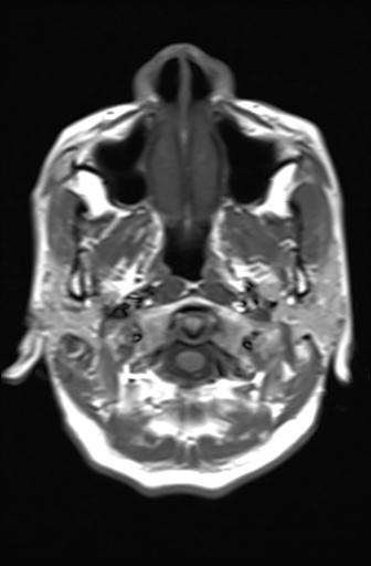 File:Acoustic schwannoma - probable (Radiopaedia 20386-20292 Axial T1 1).jpg