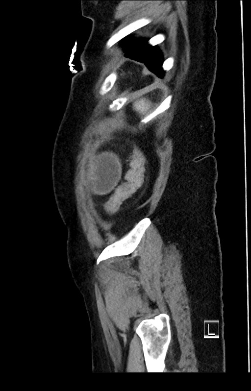 Active Crohn disease (Radiopaedia 59394-66750 Sagittal C+ portal venous phase 7).jpg