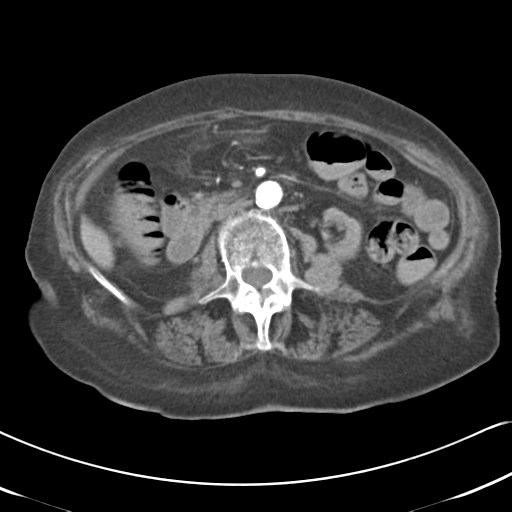 File:Active bleeding from duodenal ulcer with embolization (Radiopaedia 34216-35481 Axial C+ arterial phase 28).png