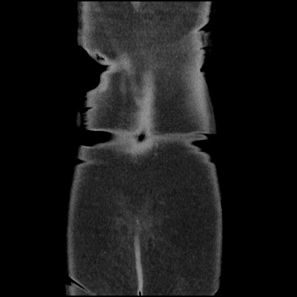 Active colonic bleed on CT (Radiopaedia 49765-55025 Coronal non-contrast 54).jpg