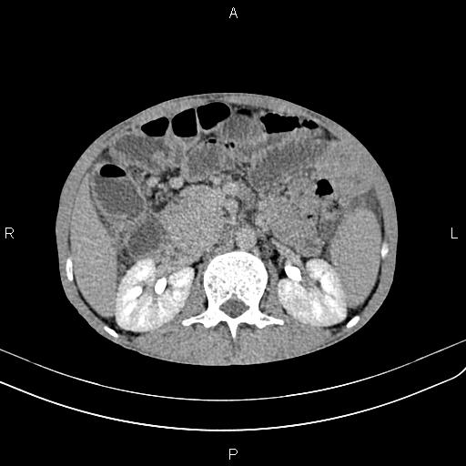Active crohn disease (Radiopaedia 87133-103397 Axial C+ delayed 17).jpg