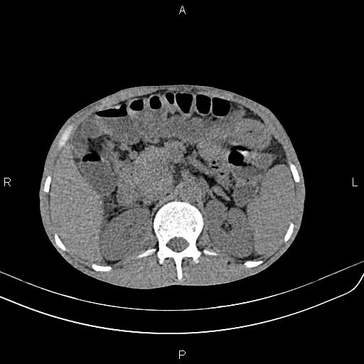 File:Active crohn disease (Radiopaedia 87133-103397 Axial non-contrast 33).jpg
