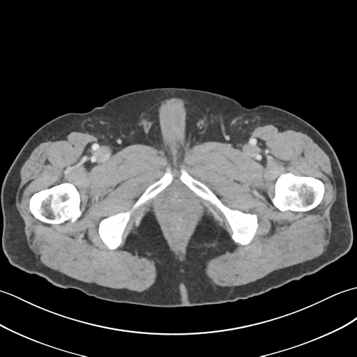 File:Active diverticular hemorrhage (Radiopaedia 39415-41725 Axial C+ portal venous phase 77).png