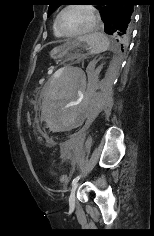 Active renal extravasation with large subcapsular and retroperitoneal hemorrhage (Radiopaedia 60975-68796 Sagittal C+ portal venous phase 81).jpg