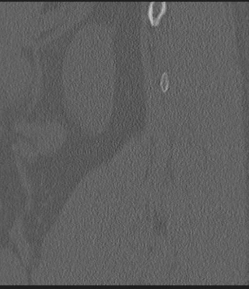 Acute L1 burst compression fracture (Radiopaedia 34430-35755 Sagittal bone window 8).png