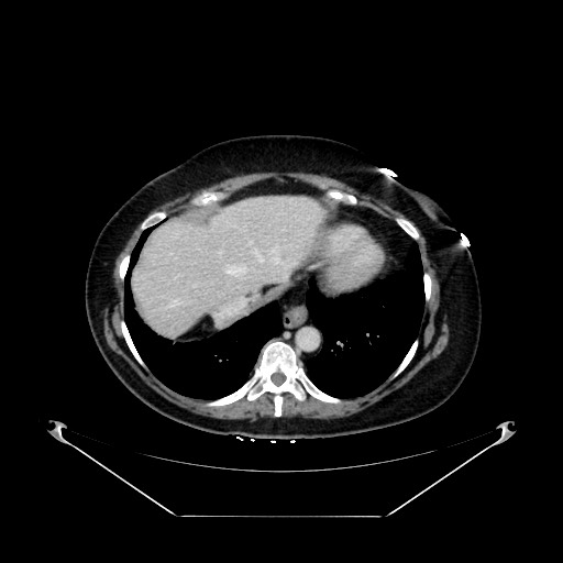 Acute appendicitis, heterotaxy syndrome (Radiopaedia 66884-76202 Axial C+ portal venous phase 18).jpg
