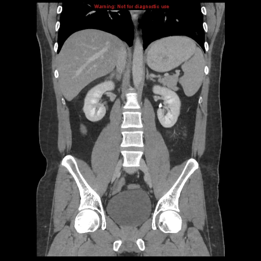File:Acute appendicitis (Radiopaedia 10498-10973 F 26).jpg