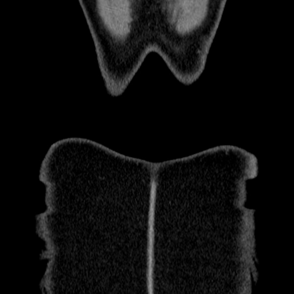 Acute appendicitis (Radiopaedia 38255-40270 Coronal C+ portal venous phase 91).jpg