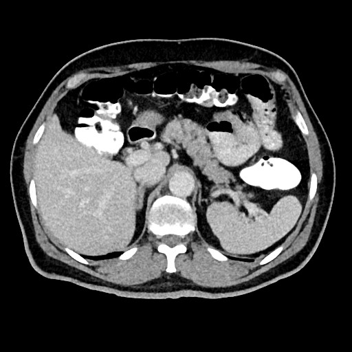 Acute appendicitis (Radiopaedia 77016-88960 Axial C+ portal venous phase 40).jpg