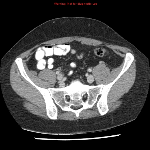 Acute appendicitis (Radiopaedia 7966-8812 C+ portal venous phase 39).jpg