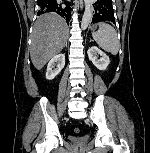 Acute appendicitis (Radiopaedia 79950-93224 Coronal C+ portal venous phase 64).jpg