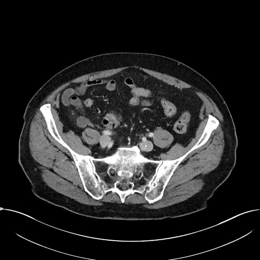 Acute appendicitis - large appendicoliths (Radiopaedia 61805-69820 Axial C+ portal venous phase 96).jpg
