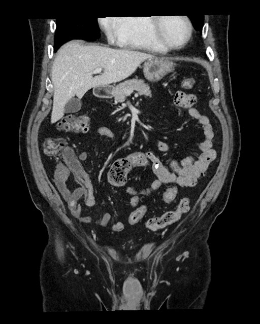 Acute appendicitis - large appendicoliths (Radiopaedia 61805-69820 Coronal C+ portal venous phase 46).jpg