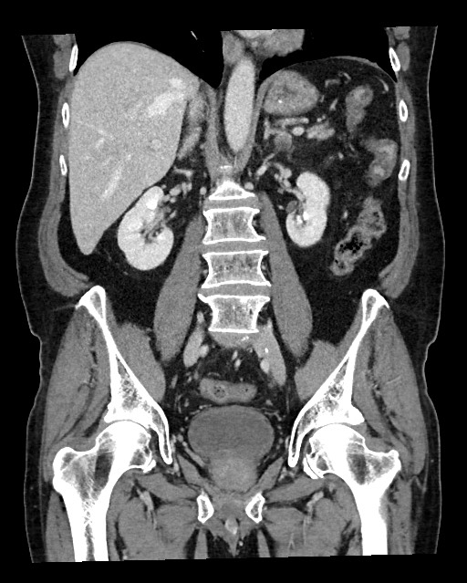 Acute appendicitis - large appendicoliths (Radiopaedia 61805-69820 Coronal C+ portal venous phase 78).jpg