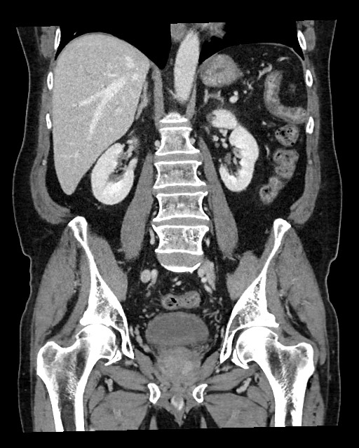 Acute appendicitis - large appendicoliths (Radiopaedia 61805-69820 Coronal C+ portal venous phase 81).jpg