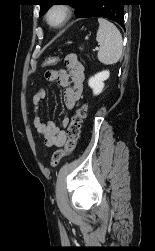 Acute appendicitis - large appendicoliths (Radiopaedia 61805-69820 Sagittal C+ portal venous phase 26).jpg