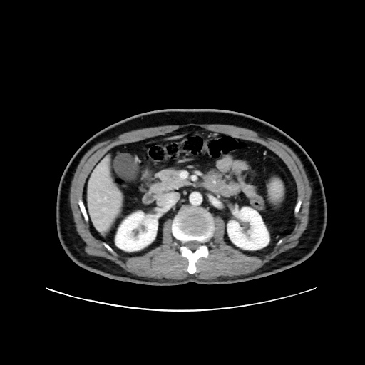Acute appendicitis and COVID 19 pneumonia (Radiopaedia 76604-88380 Axial C+ portal venous phase 31).jpg