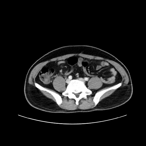 Acute appendicitis and COVID 19 pneumonia (Radiopaedia 76604-88380 Axial C+ portal venous phase 56).jpg