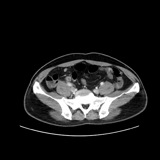 Acute appendicitis and COVID 19 pneumonia (Radiopaedia 76604-88380 Axial C+ portal venous phase 61).jpg