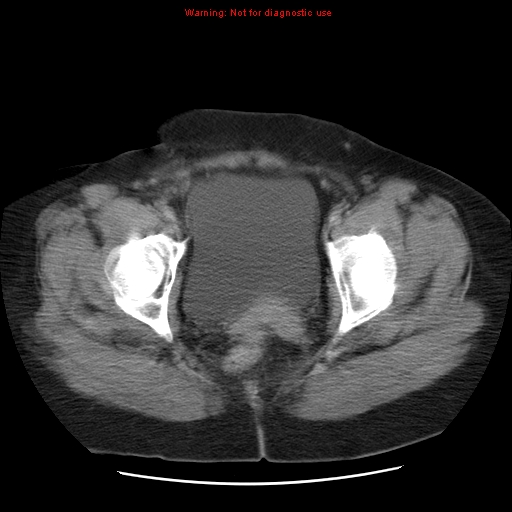 Acute appendicitis complicated by ovarian vein thrombophlebitis (Radiopaedia 16172-15851 Axial C+ portal venous phase 81).jpg