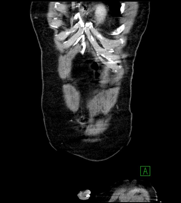 Acute arterial mesenteric ischemia (Radiopaedia 78238-90828 Coronal C+ portal venous phase 17).jpg