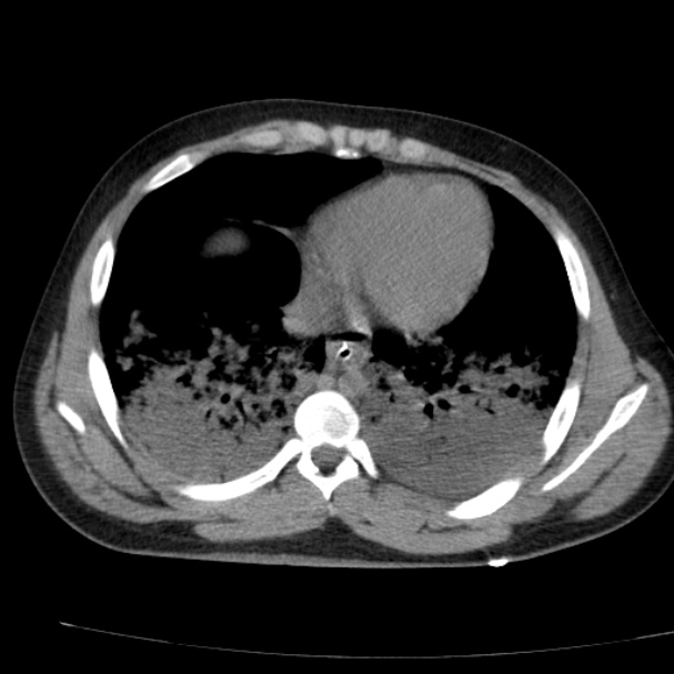 Acute aspiration pneumonitis (Radiopaedia 33605-34703 Axial non-contrast 60).jpg