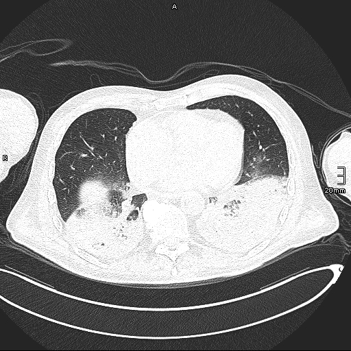 Acute aspiration pneumonitis (Radiopaedia 55642-62166 Axial lung window 106).jpg