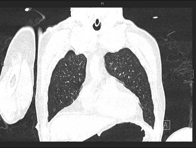 Acute aspiration pneumonitis (Radiopaedia 55642-62166 Coronal lung window 22).jpg