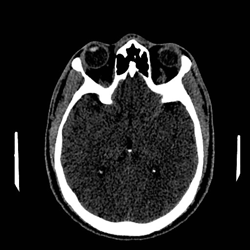 Acute basilar artery occlusion (Radiopaedia 43582-46985 Axial non-contrast 88).jpg