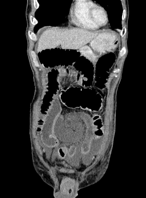 Acute bowel ischemia (Radiopaedia 87695-104114 Coronal C+ portal venous phase 112).jpg