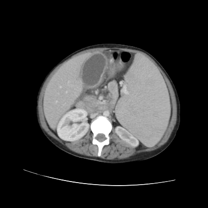 Acute calculous cholecystitis in patient with osteopetrosis (Radiopaedia 77871-90159 Axial C+ portal venous phase 41).jpg