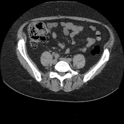 Acute cholecystitis and ureteric colic (Radiopaedia 42330-45444 Axial prone 70).jpg