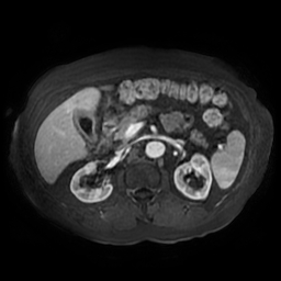 File:Acute cholecystitis complicated by pylephlebitis (Radiopaedia 65782-74915 Axial arterioportal phase T1 C+ fat sat 70).jpg