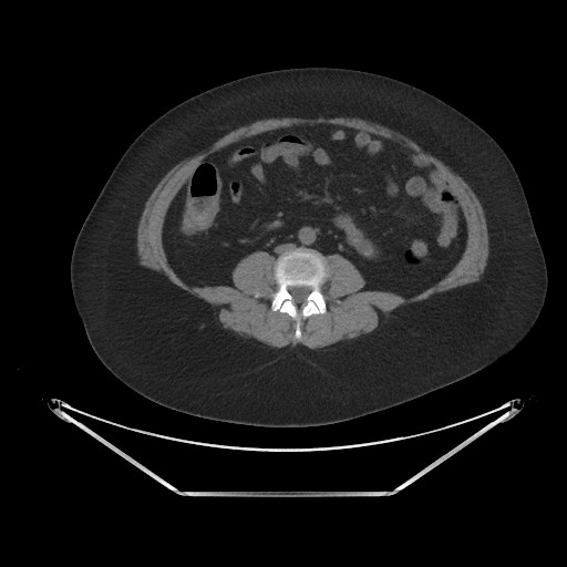 File:Acute cholecystitis with tensile fundus sign (Radiopaedia 71394-81723 Axial non-contrast 60).jpg
