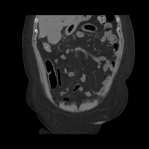 Acute cholecystitis with tensile fundus sign (Radiopaedia 71394-81723 Coronal non-contrast 45).jpg