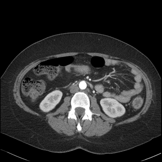 Acute colonic hemorrhage in ulcerative colitis (Radiopaedia 77415-89538 Axial C+ arterial phase 63).jpg