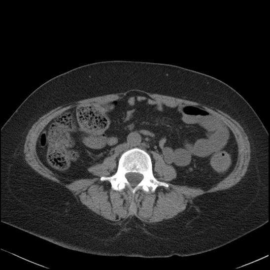 Acute colonic hemorrhage in ulcerative colitis (Radiopaedia 77415-89538 Axial non-contrast 77).jpg