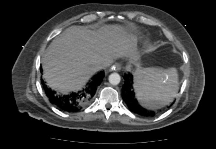Acute cor pulmonale (ultrasound) (Radiopaedia 83508-98818 Axial C+ CTPA 68).jpg