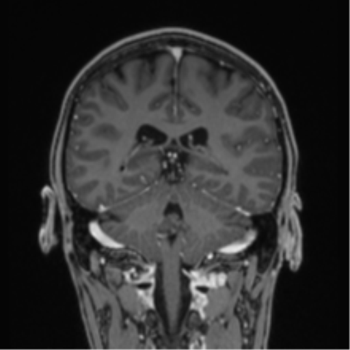 Acute disseminated encephalomyelitis (ADEM) (Radiopaedia 65319-74349 Coronal T1 C+ 12).png