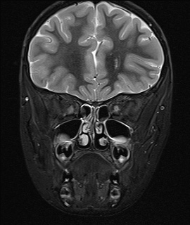 File:Acute disseminating encephalomyelitis with bilateral optic neuritis (Radiopaedia 79676-92886 Coronal STIR 9).jpg