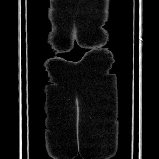 Acute diverticulitis - transverse colon (Radiopaedia 87063-103327 Coronal C+ portal venous phase 163).jpg