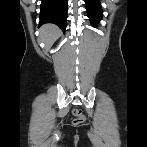 File:Acute diverticulitis with localized perforation (Radiopaedia 41296-44113 Coronal C+ portal venous phase 52).jpg