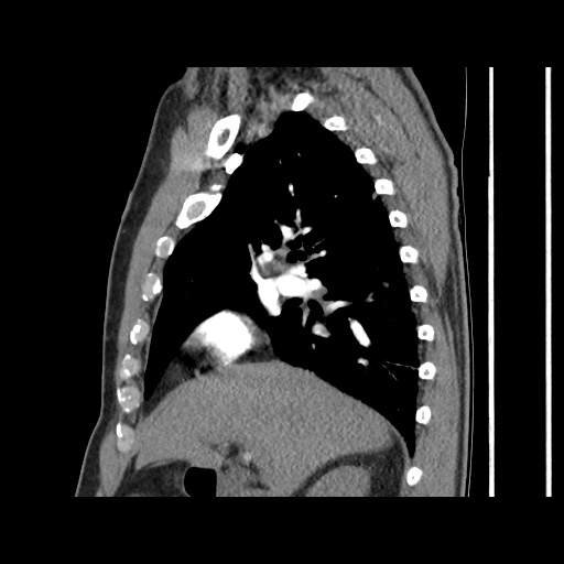 Acute epicardial fat necrosis (Radiopaedia 42327-45440 Sagittal C+ CTPA 28).jpg
