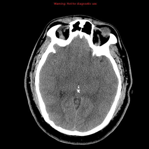 Acute hemorrhagic leukoencephalitis (Radiopaedia 14076-13920 Axial non-contrast 21).jpg