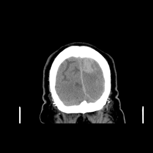Acute hemorrhagic stroke (Radiopaedia 17507-17223 Coronal non-contrast 53).jpg
