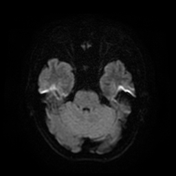 File:Acute hippocampal infarction (Radiopaedia 10610-11072 DWI 1).jpg